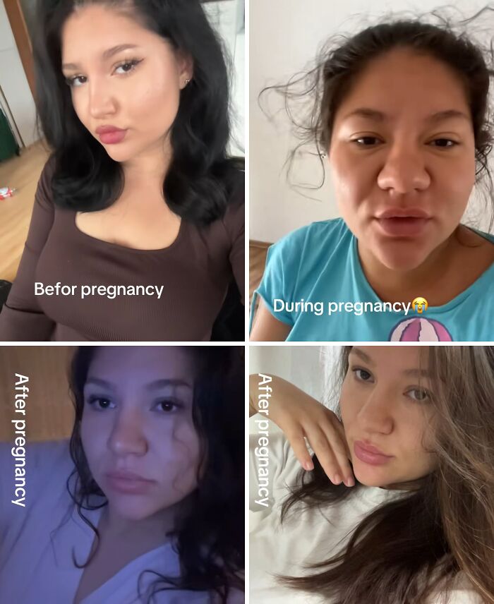 Yep, Pregnancy Nose Is Totally Real