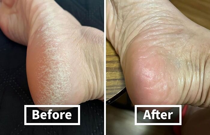 Feel Like Walking On Hot Coals? This Callus Remover Will Give Your Feet a Happy Ending