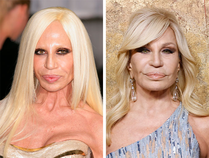 Mini or Micro Facelifts? Yeah, Nope, Those Don’t Really Exist