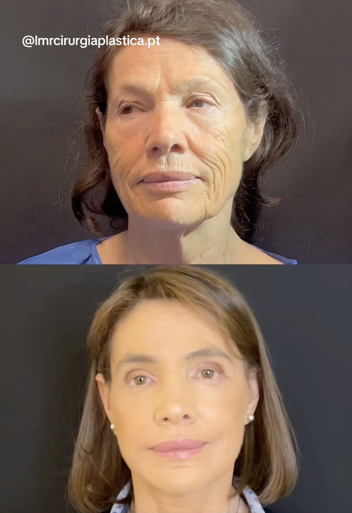 Wait Till You See These Plastic Surgery Before-And-Afters!