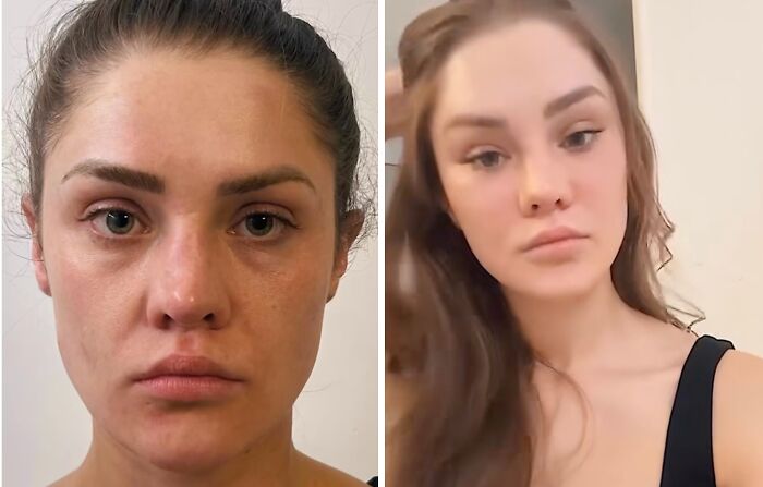 Wait Till You See These Plastic Surgery Before-And-Afters!
