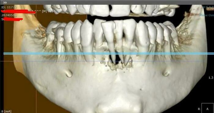 That Time My Jaw Had A Surprise Hole