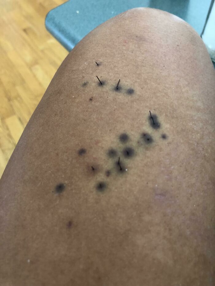 Sea Urchin: 1 - My Thigh: 0