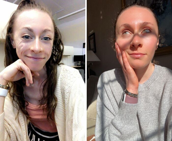 Anorexia Recovery Glow-Up