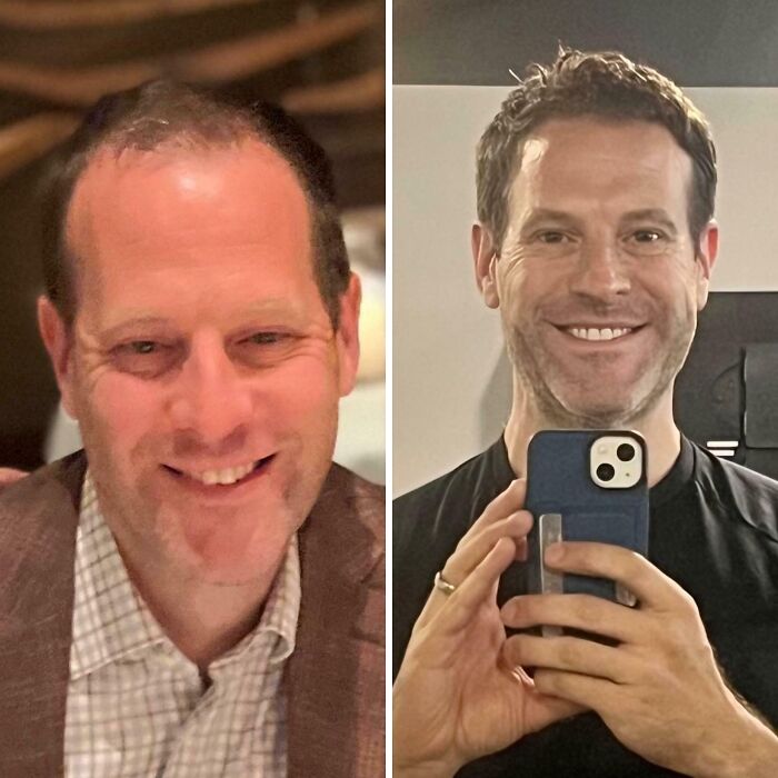 Hair Transplant Glow-Up