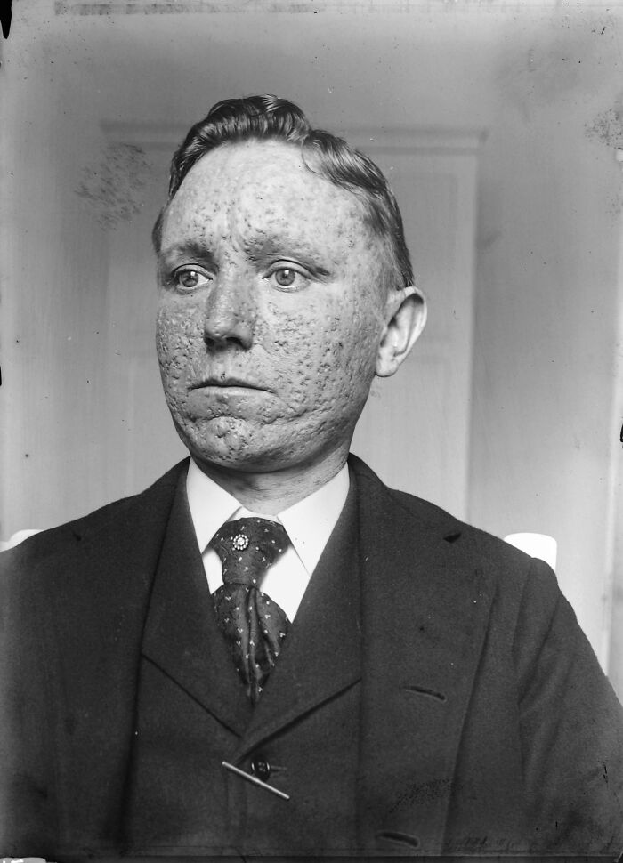 Recovered Smallpox Scars Captured by Dr. Corlett, Early 1900s
