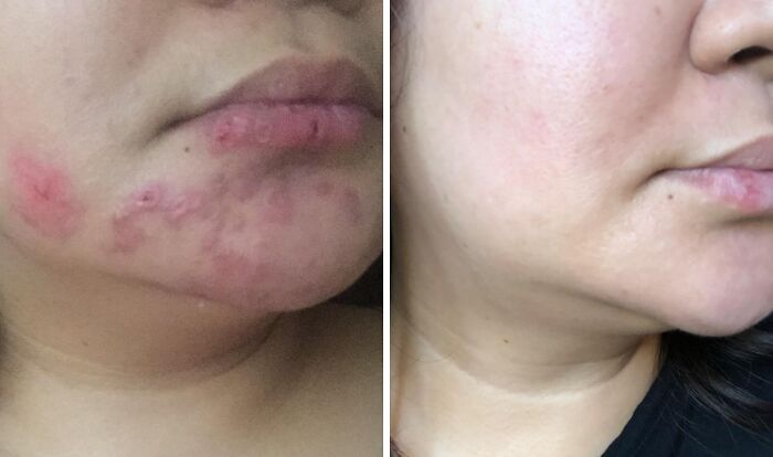 Avoid Turning Into A Dry Mummy This Winter With Bio-Oil Skincare Body Oil.