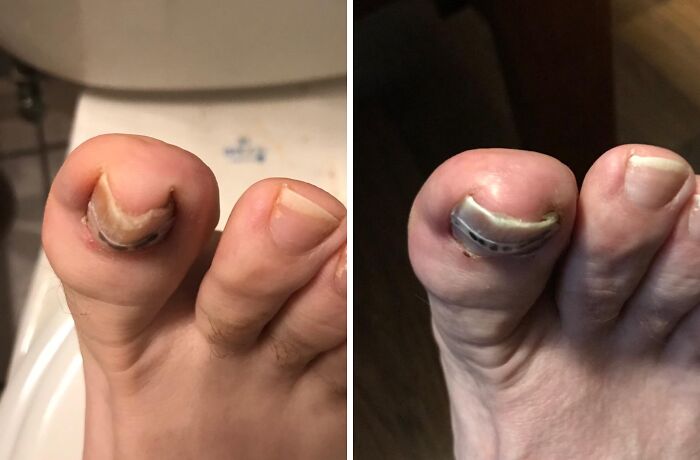 Stop Your Big Toe's Battle With Skin Using This Ingrown Toenail Treatment Kit.