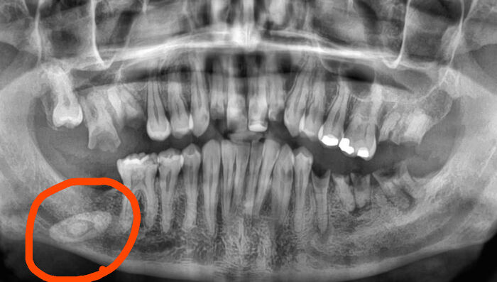 X-Ray Surprise: Mega Saliva Stone Found!