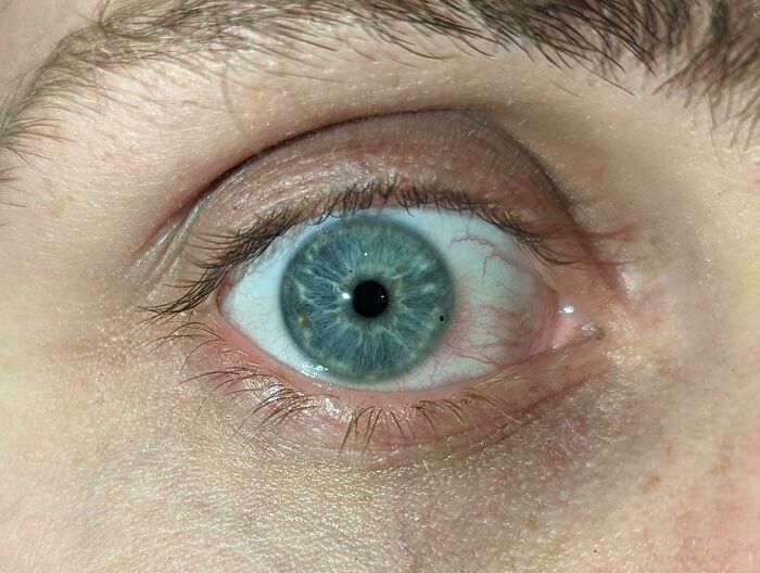 Metal Can Sneak Into Your Eye Even With Safety Glasses — Wear Goggles!