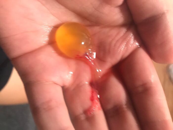 This Creepy Thing Came Out of My Girlfriend’s Nose—What Is It?!