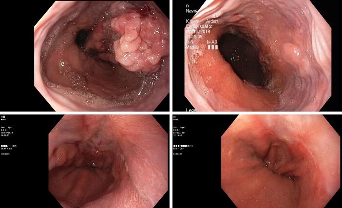 Ever Wonder What an Esophagus Tumor Looks Like? Here’s Chemo in Action