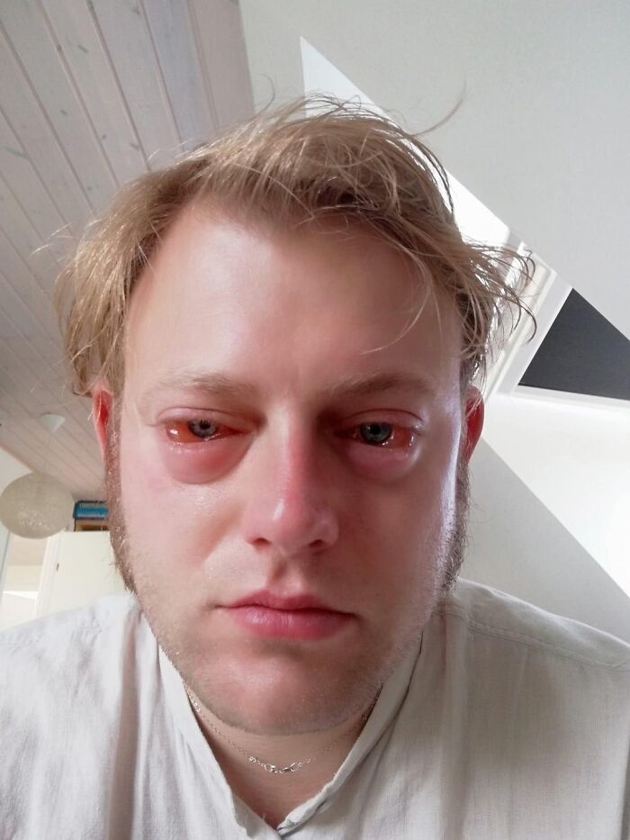 My Friend’s Hay Fever Turned His Face Into Fish-Face—Literally