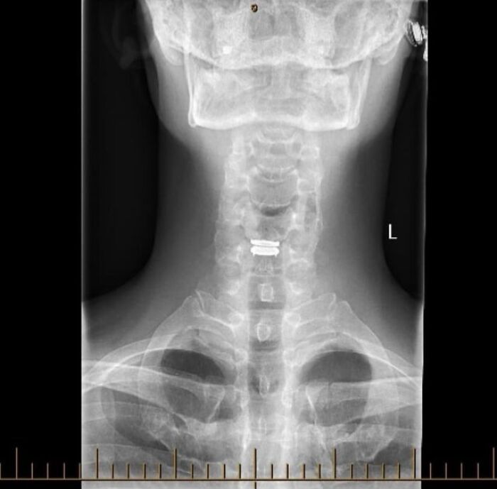 Check Out My New Neck Disc! Just Thought You’d Like to See It