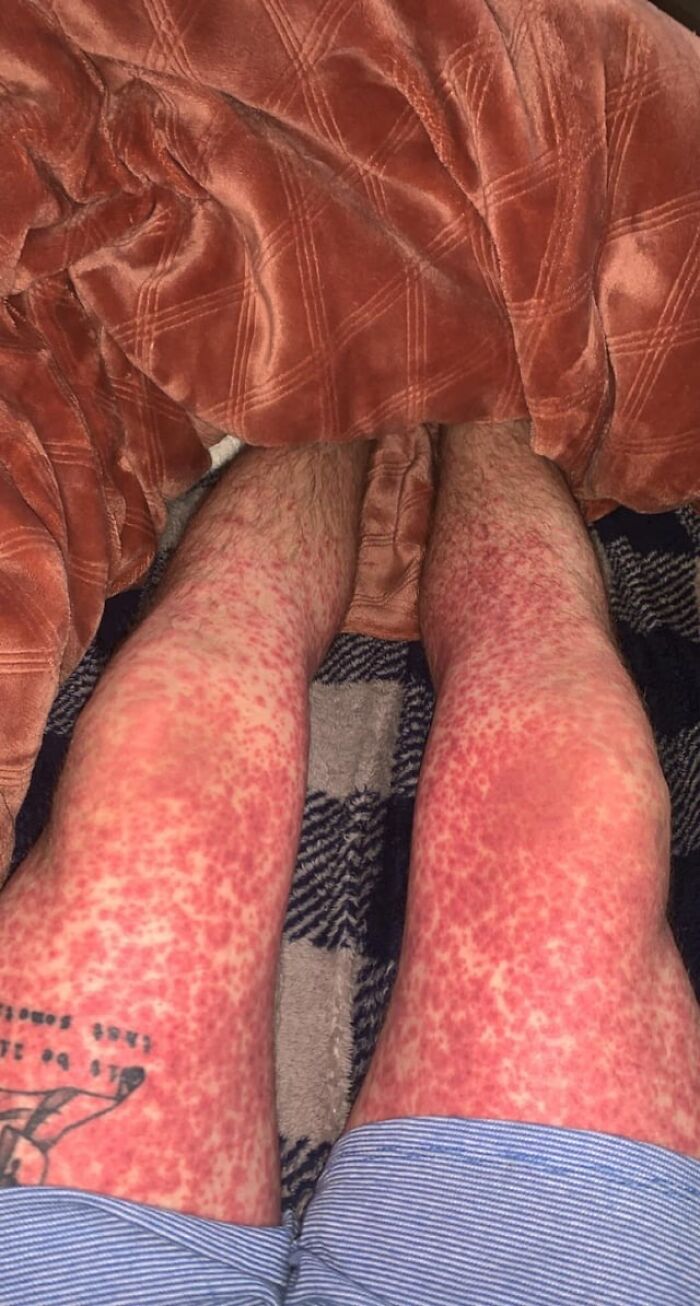 Epic Skin Rash from Antibiotics—Not the Look I Was Going For