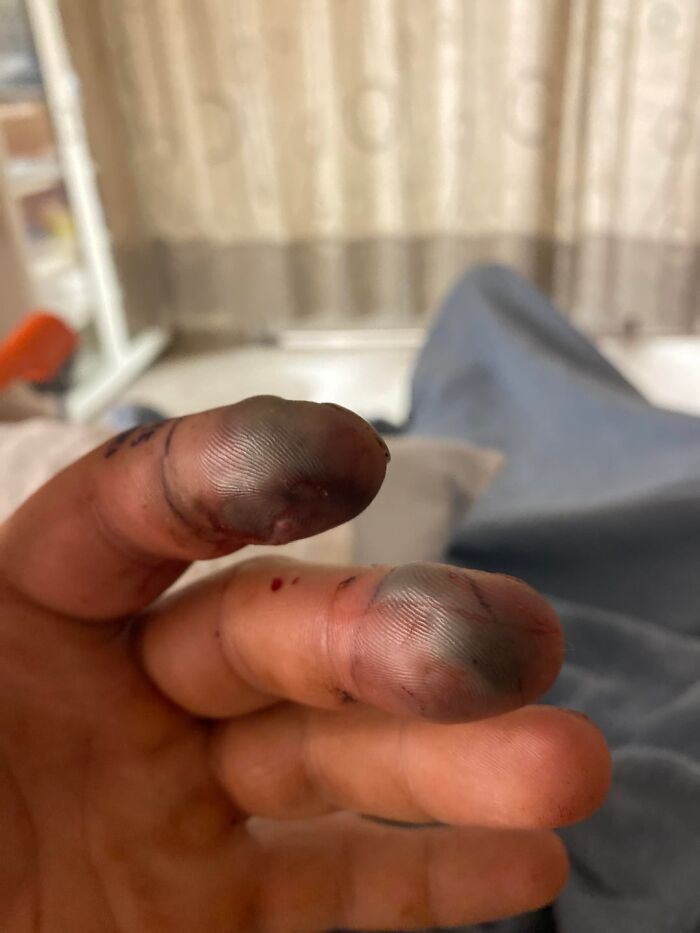 Snake Bite Emergency: Cottonmouth Didn’t Mess Around