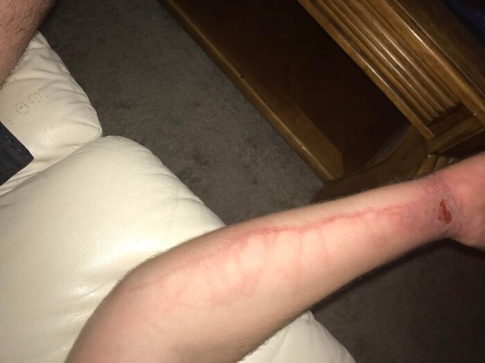 My Girlfriend’s Infected Poison Ivy: Gross but Real