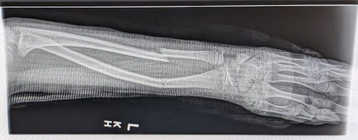 My 9-Year-Old Broke Her Arm. Doc Said She’ll Be Fine, But Should I Worry?