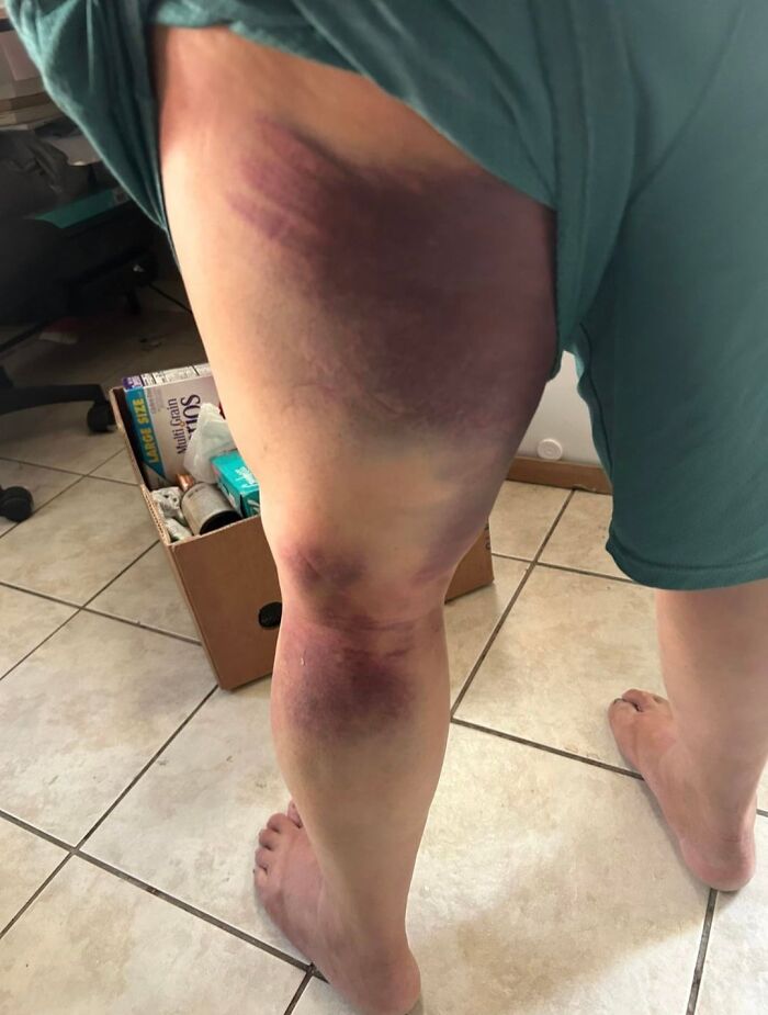 I Fell and Woke Up Looking Like This. Fun Times!