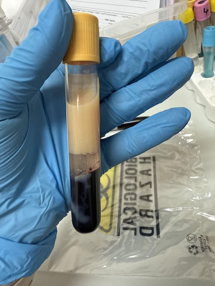 Blood Sample from a 34-Year-Old—Looking Real Sciencey