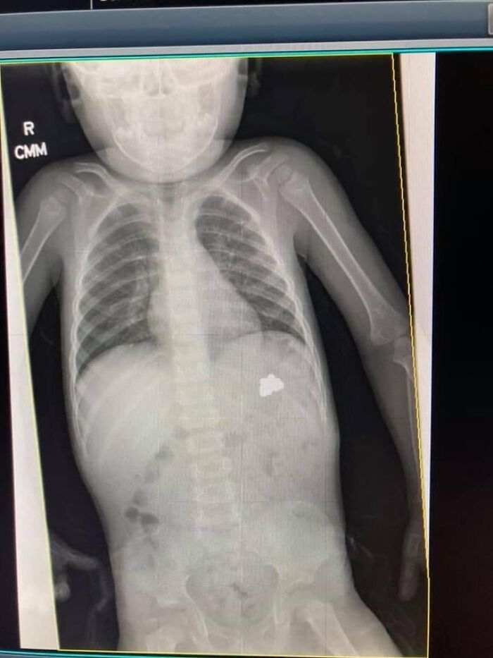 My Toddler Swallowed My Butterfly-Shaped Ring—Whoops!