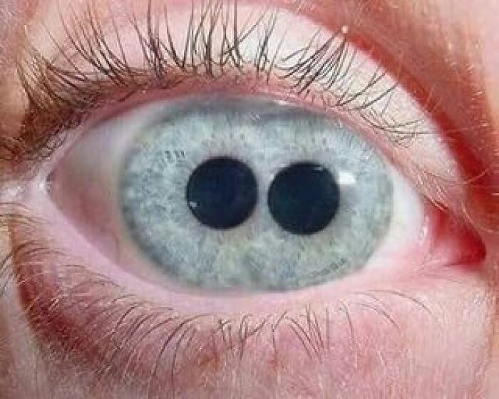 People with Two Pupils in One Eye? Do They See Double?