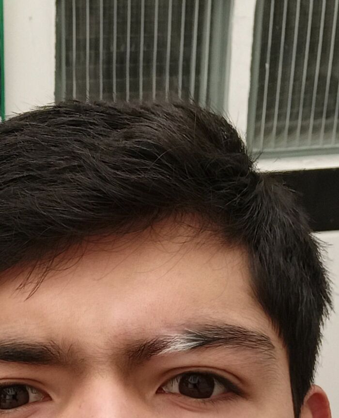 Is This Vitiligo or Something Else Turning My Eyebrow White?