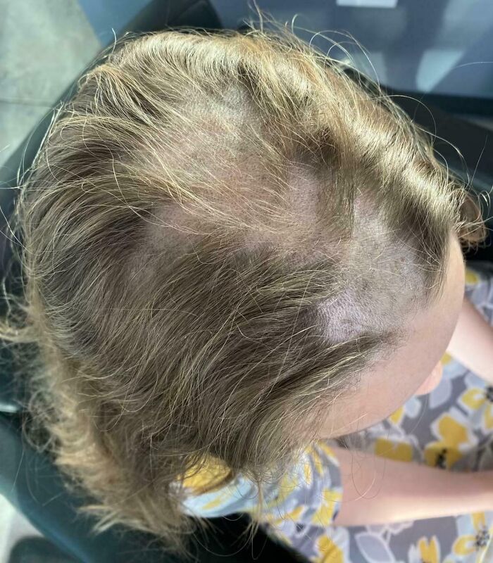 Nair Accident on Head — Help!
