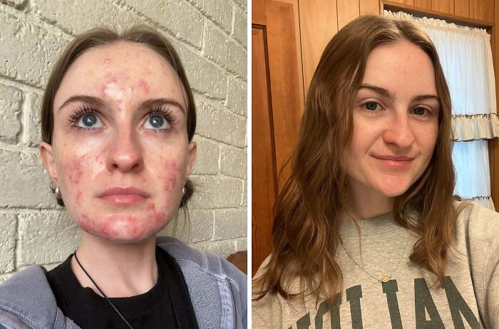 One Year On Tretinoin And Skin Glow-Up! So Pleased With The Results