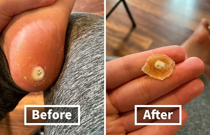Kick That Pesky Foot Corn To The Curb With These Easy Corn Remover Pads