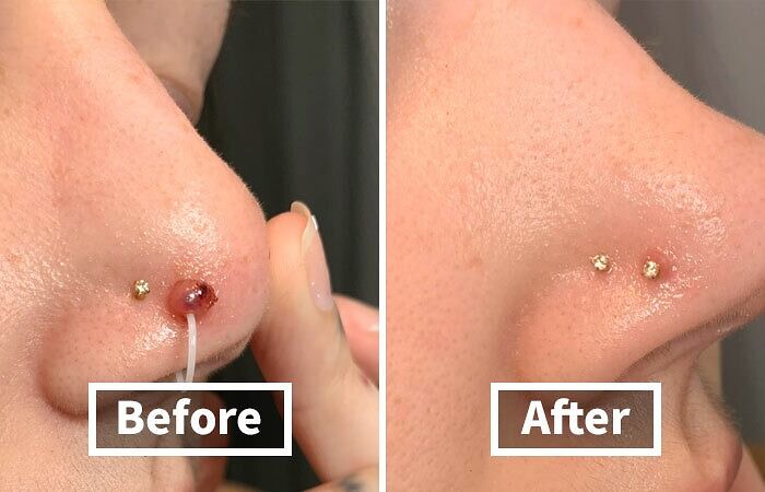 Tell That Piercing Bump To Take A Hike With This Keloid Bump Oil