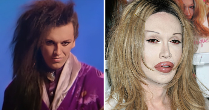 Pete Burns: The Surgery King