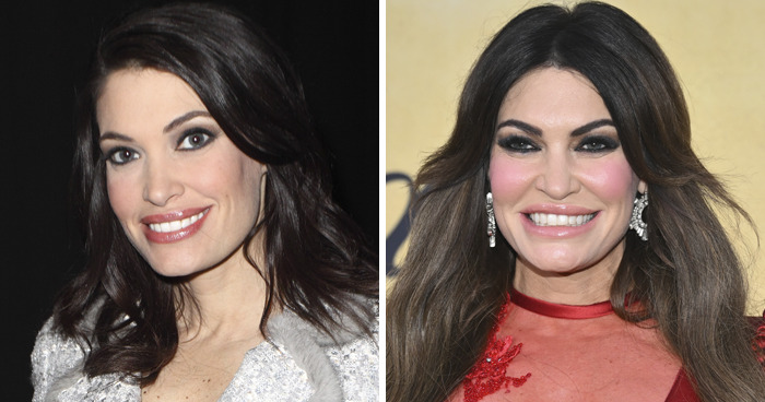 Kimberly Guilfoyle: The ‘Frozen’ Forehead Queen