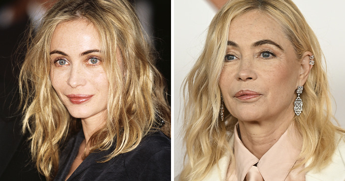 Emmanuelle Béart: Lip Job Gone Wrong