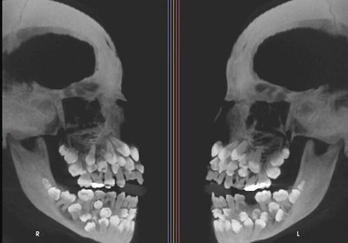 This Person Had 81 Teeth (!) When Most Adults Have Only 32 - Talk About a Mouthful