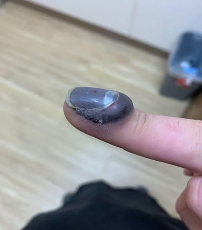 Finger Got Stuck In Car Door – Pain Level: Expert