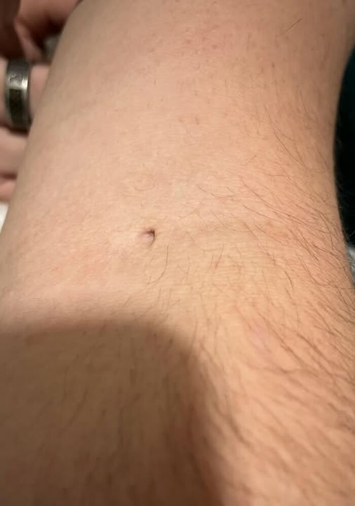 Husband Donated Plasma So Much, He’s Got a Permanent Hole