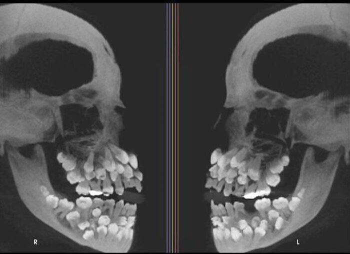 X-Ray of A Tooth Hoarder: 81 Teeth!