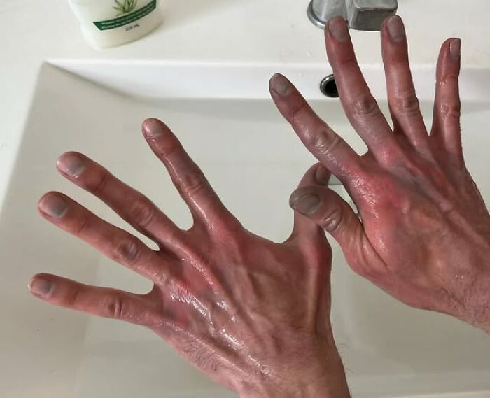 Hands Turned Pink & Purple After An Hour Outside In Cold