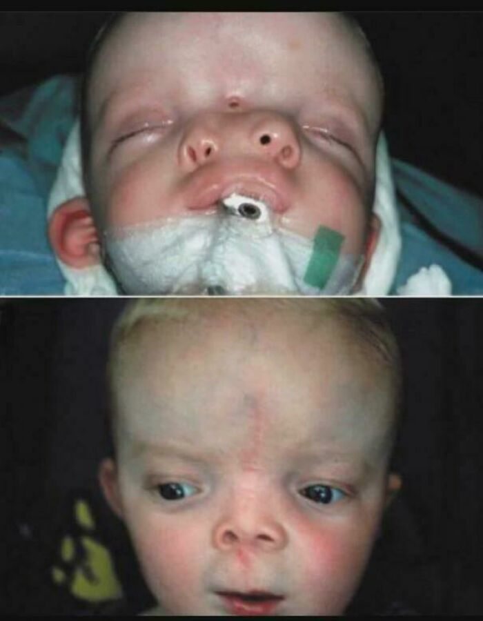 Craniofacial Duplication Surgery: Witness The Stunning Before & After