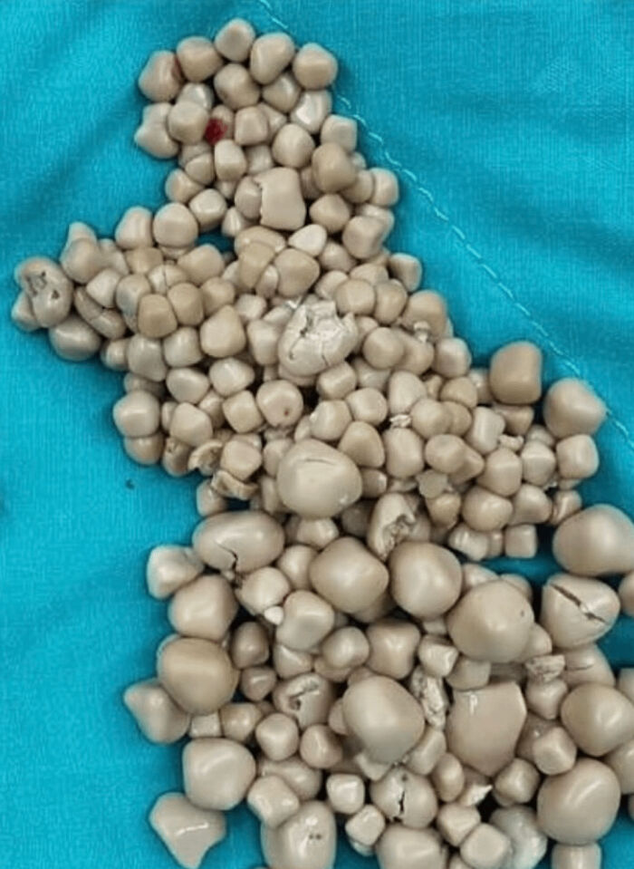 300 Kidney Stones? Yes, You Read That Right!