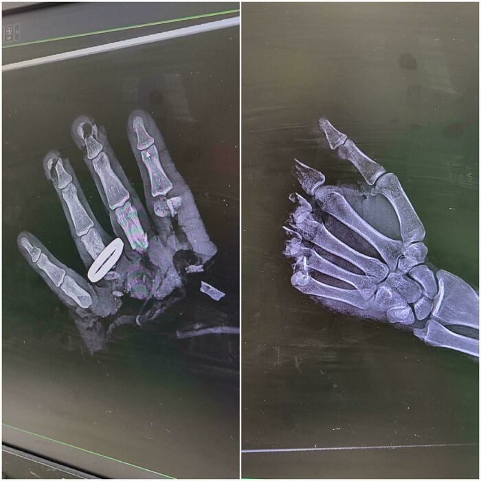 Chainsaw Accident Captured In an X-Ray Like a Horror Movie Scene