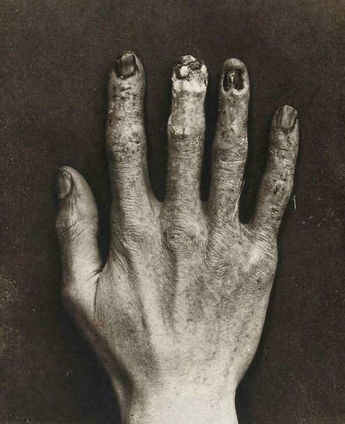 Radiation Damage From Back in the Early 1900s—The X-Ray Tech’s Hand Says It All