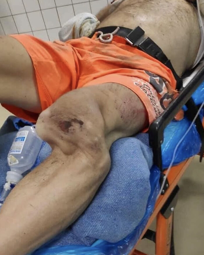 Ouch! Motorcycle Crash Caused a Serious Knee Dislocation