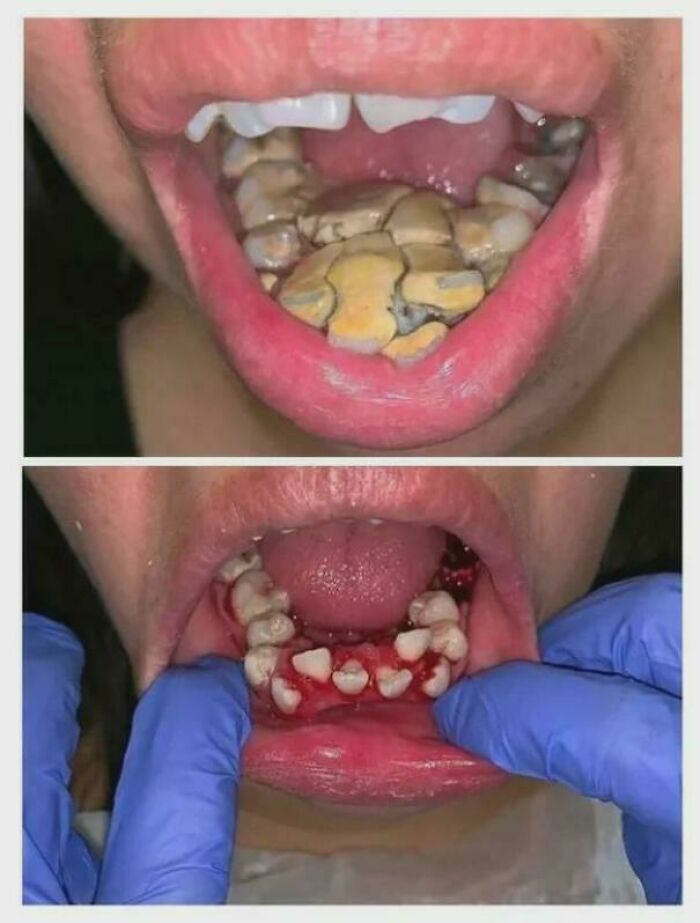 Heavy Calculus Removal: When Teeth Throw a Rock Party