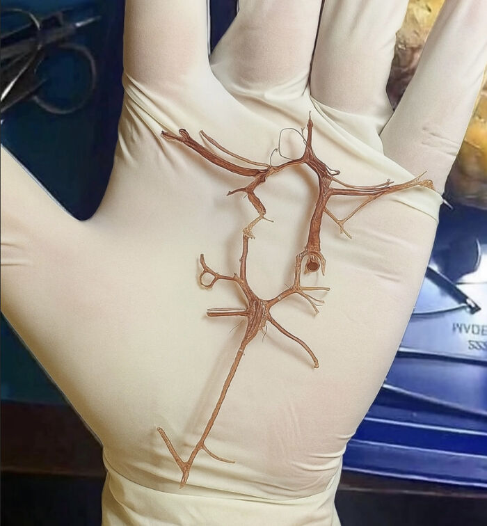 The Circle of Willis: A Brain Artery Ring That Keeps You Alive