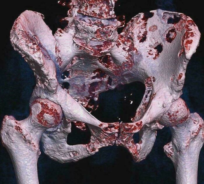 3D CT Scan of Hip Bone Cancer Spots