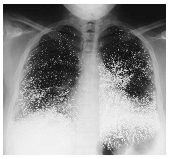21-Year-Old Dental Assistant’s Chest X-Ray After a Crazy Mercury Incident