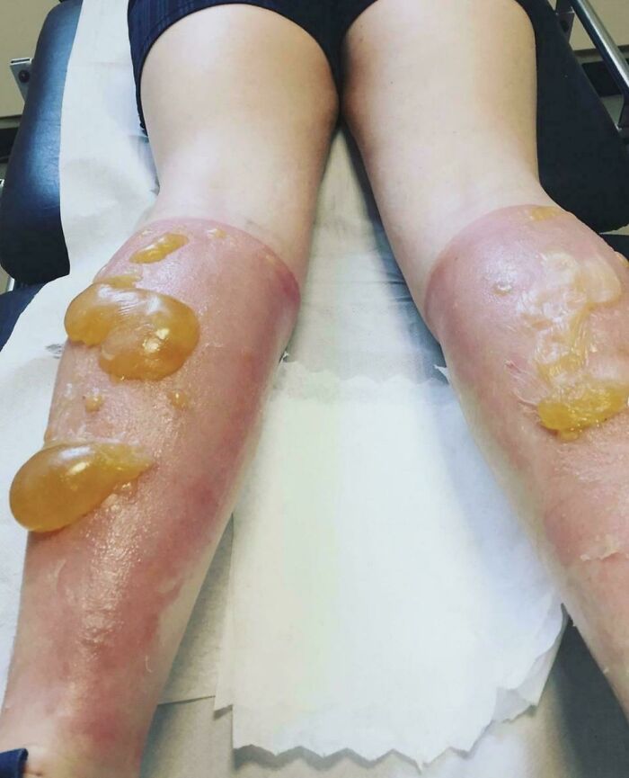Ultra Marathon Sunburn Horror: Massive Blisters After 69 Miles