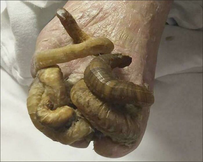 Onychogryphosis: When Nails Grow Like Ram's Horns